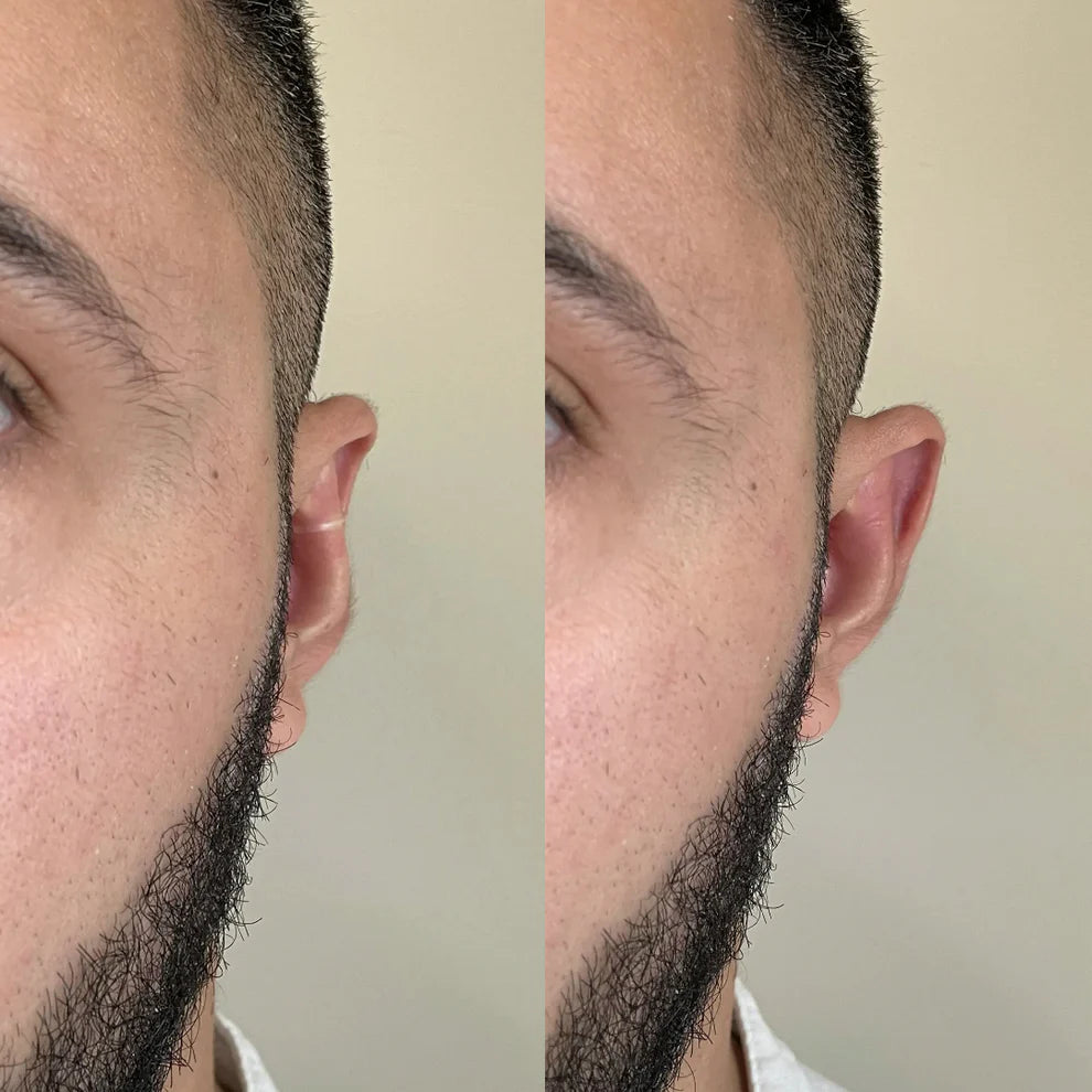 EarSculpt™ Transparent Protruding Ear Corrector